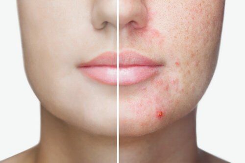 Online Assessment of Premenstrual Acne